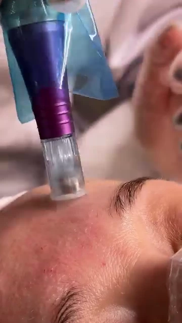 Close view of a microneedling pen in contact with facial skin.